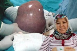 Karın ağrısı şikayetiyle hastaneye gitti rahminden 5 kilogramlık t&uuml;m&ouml;r &ccedil;ıkarıldı