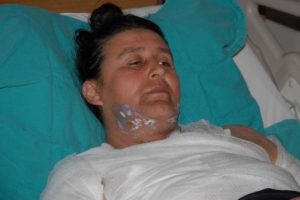 Bursa'da kocasının sevgilisi tarafından &uuml;zerine sıcak su d&ouml;k&uuml;ld&uuml;