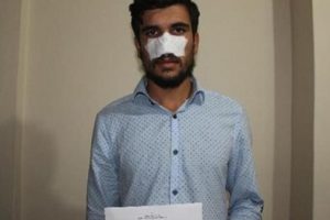 Kavga ettiği kuzeni burnunu kopardı