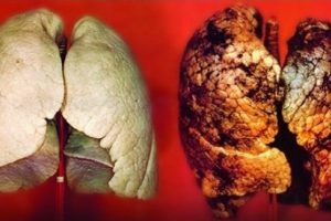 &Ouml;l&uuml;m vakalarında akciğer kanseri birinci sırada