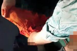 Şiddetli karın ağrısı şikayetiyle doktora giden kadının karnından havlu &ccedil;ıktı!