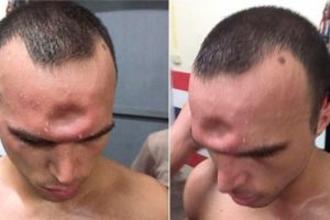 Muay Thai boks&ouml;r&uuml;n&uuml;n kafası kırıldı!