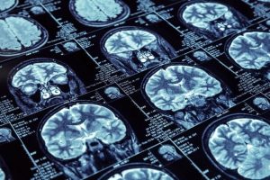 Temporal lob epilepsi nedir?