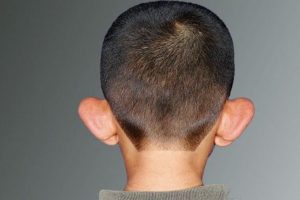 Kepçe kulak çocuklarda mobing etkisi yapıyor