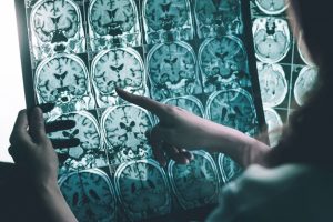 Alzheimer'ın en b&uuml;y&uuml;k d&uuml;şmanı a&ccedil;ıklandı!