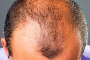 Erkeklerde saç kayıplarının ne kadarı genetik?