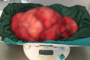 13,5 kiloluk tümör başarıyla çıkarıldı