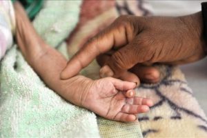 Yemenli &ccedil;ocuklar a&ccedil;lıkla m&uuml;cadele ediyor
