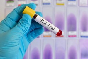 Lupus hastalığı nedir?