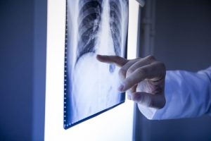 Sigara i&ccedil;en don&ouml;rden nakledilen organ hastayı kanserden &ouml;ld&uuml;rd&uuml;