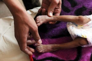 Yemen'de yaklaşık 85 bin &ccedil;ocuk yetersiz beslenmeden &ouml;lm&uuml;ş!