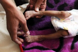 ICRC'nin Ortadoğu'daki s&ouml;zc&uuml;s&uuml; Zevkari: Milyonlarca Yemenli a&ccedil; uyuyor