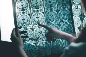 Bu keşif alzheimer hastalarına ila&ccedil; olacak!