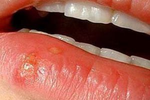 Herpes nasıl oluşur?&nbsp;