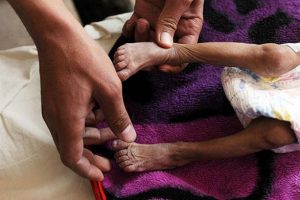 "Yemen'de &ccedil;ocuklar bir deri bir kemik"