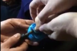 &Ouml;ğrencinin parmağını sıkıştırdığı su termosu kapağı kesilerek &ccedil;ıkartıldı