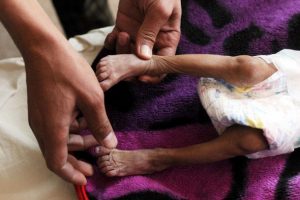 Yemen'deki savaş insanlık dramına d&ouml;n&uuml;şt&uuml;
