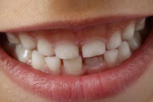 &Ccedil;ocuğun dişi kırıldığında ya da &ccedil;ıktığında ne yapılmalı?