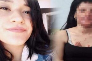 Korkun&ccedil;! Nişanlısı y&uuml;z&uuml;n&uuml; bu hale getirdi