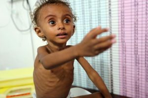"Yemen'de 100 bin &ccedil;ocuk koleraya yakalandı"