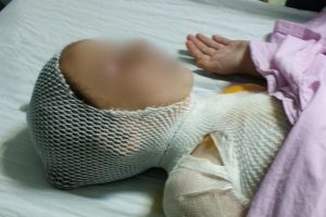 Kaynatılırken taşan s&uuml;t &ccedil;ocuğu hastanelik etti