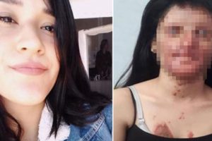 Asitli saldırıya uğrayan Berfin'den haber var