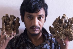 Bangladeşli 'ağa&ccedil; adam' ellerinin kesilmesini istedi