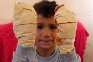 K&uuml;&ccedil;&uuml;k &ccedil;ocuğun eline kolonya d&ouml;k&uuml;p ateşe verdi