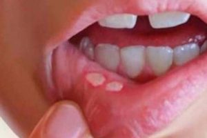 HIV vir&uuml;s&uuml; ağızda belirti veriyor