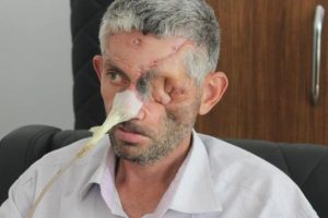 Dişini &ccedil;ektiren adam g&ouml;z&uuml;n&uuml; kaybetti!