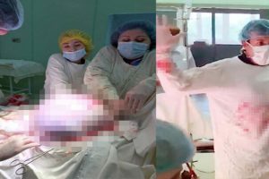 Yumurtalıklarından 25 kilogram t&uuml;m&ouml;r &ccedil;ıkarıldı