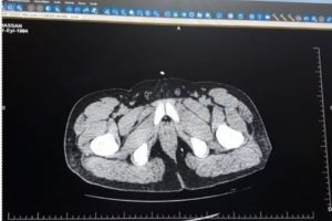 Midesinden 250 gram eroin &ccedil;ıktı