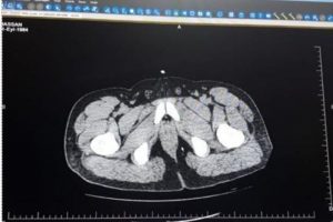 İranlı kurye, midesinde 250 gram eroinle yakalandı