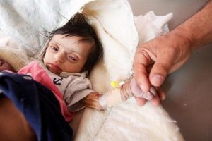 "Yemen'de 175 sağlık tesisi kapatılacak"