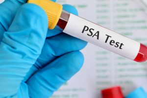 Prostat kanserinde erken teşhis PSA testiyle m&uuml;mk&uuml;n! (&Ouml;ZEL HABER)