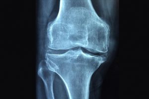 'Osteoporoz 3 kadından birini kıskacına alıyor'