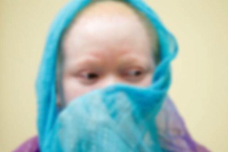 Zambiya'da albinos &ccedil;ocuğun elini kestiler