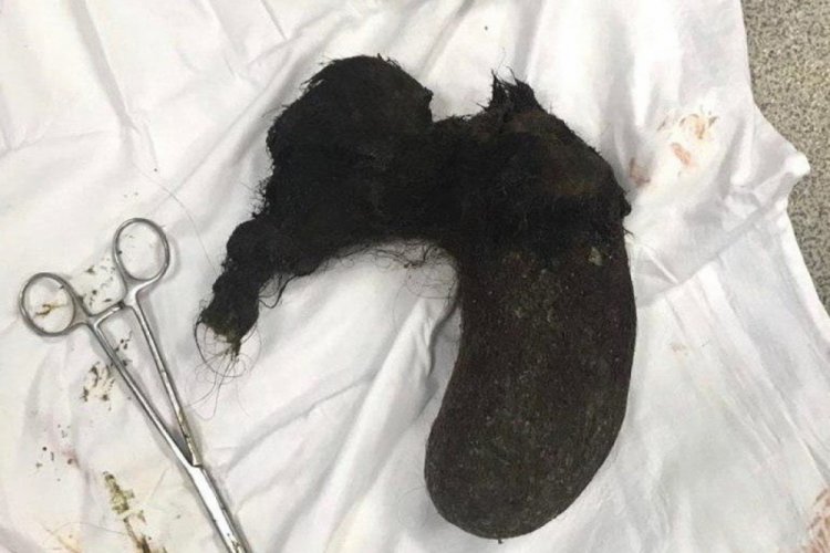 10 yıl boyunca yediği sa&ccedil;ları ameliyatla midesinden &ccedil;ıkarıldı