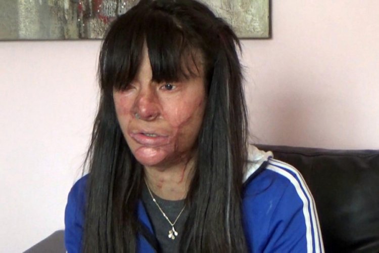 Y&uuml;z&uuml; asitle yakılan Berfin'den m&uuml;talaa tepkisi: Benim yerimde kızınız olsaydı