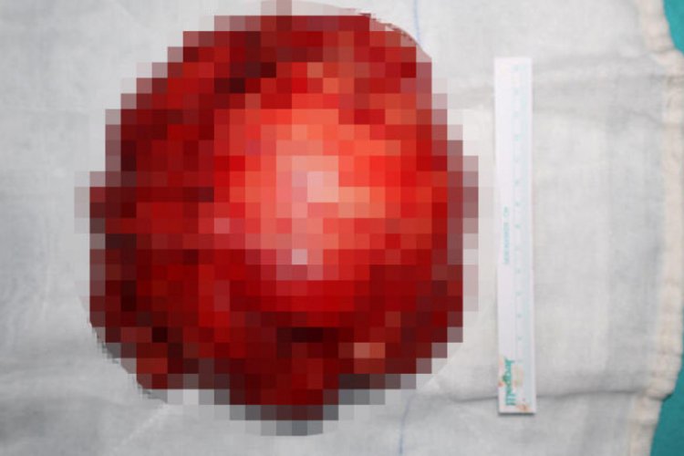 12 yaşındaki kızın memesinden yarım kiloluk t&uuml;m&ouml;r temizlendi