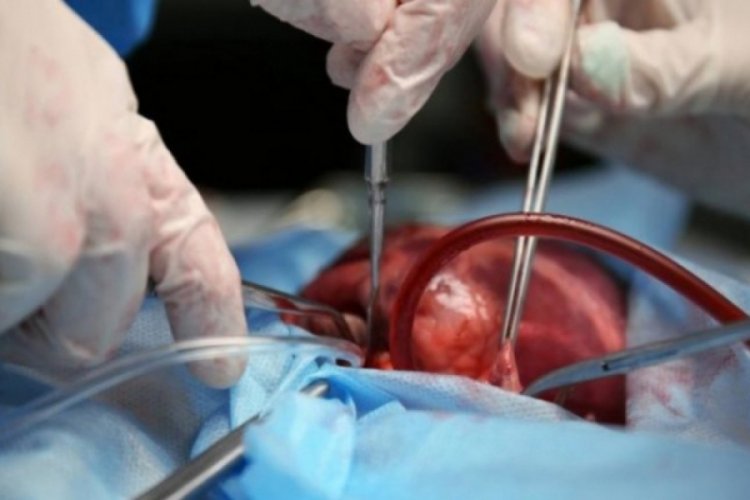 Organ naklinde d&uuml;nyada ilk &uuml;&ccedil;teyiz