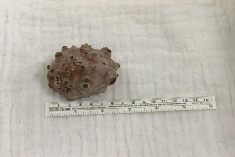 Mesanesinden 130 gramlık taş &ccedil;ıktı