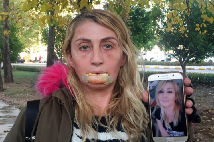G&uuml;zellik uğruna kaybettiği alt dudağı eskisi gibi olmayacak