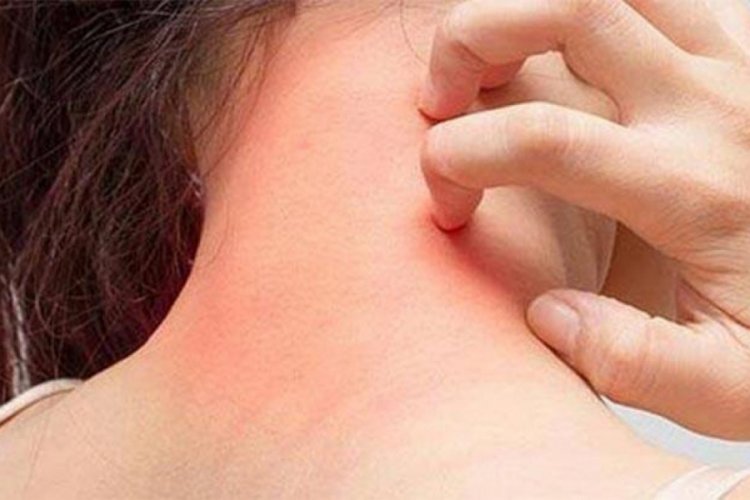 Sağlık M&uuml;d&uuml;rl&uuml;ğ&uuml;'nden 'uyuz' uyarısı!
