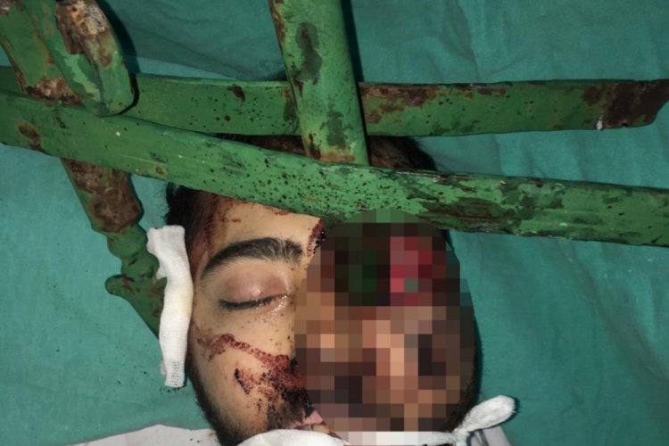 Y&uuml;z&uuml;ne demir saplanan genci, itfaiye ve plastik cerrahlar kurtardı