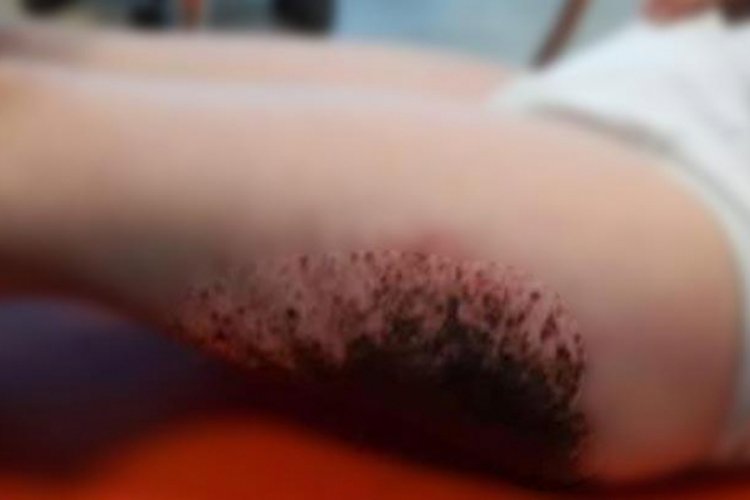 'Kartopu oynarken yanan &ccedil;ocuklardan patolojik &ouml;rnek alınmadı' iddiası