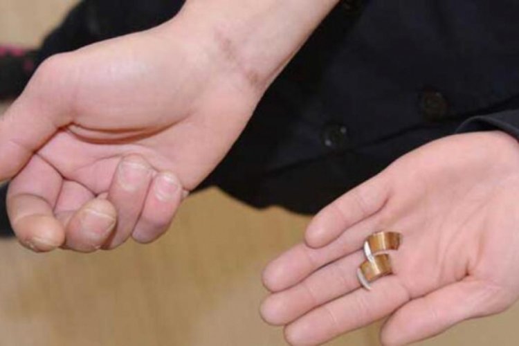 Y&uuml;z&uuml;k parmağına sıkışınca kesilerek &ccedil;ıkartıldı