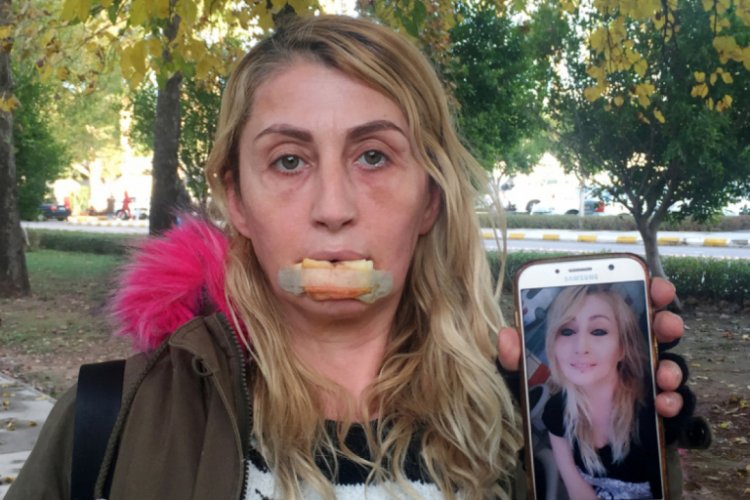 Dolgu yapılan dudağını kaybetmişti, artık yemek yiyebiliyor