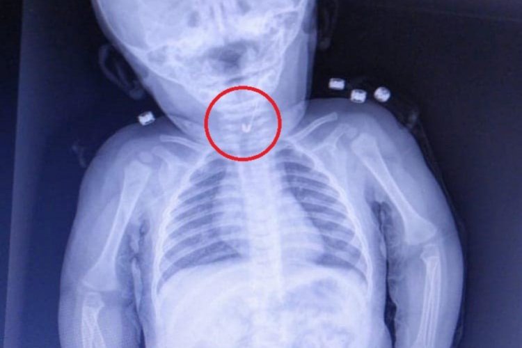7 aylık bebeğin yemek borusundan &ccedil;engelli iğne &ccedil;ıktı