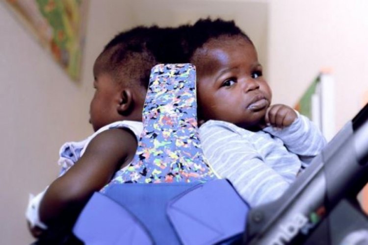 Afrikalı siyam ikizleri 18 saatlik operasyonla ayrıldı